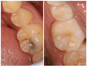 amalgam removal and replaced with cosmetic composite filling