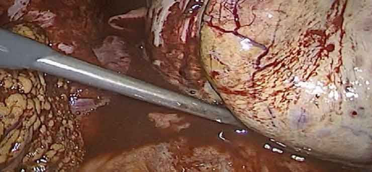 Endometriozis Tedavisi