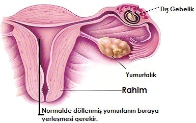 Dış Gebelik Nedir? Dış Gebelik Belirtileri Nelerdir?