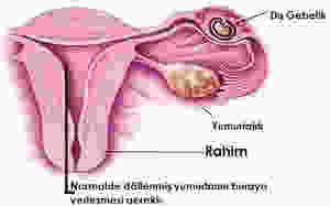 dış gebeli ankara