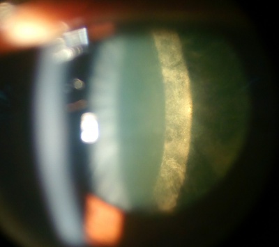 400px-Posterior_Subcapsular_Cataract-1.jpg