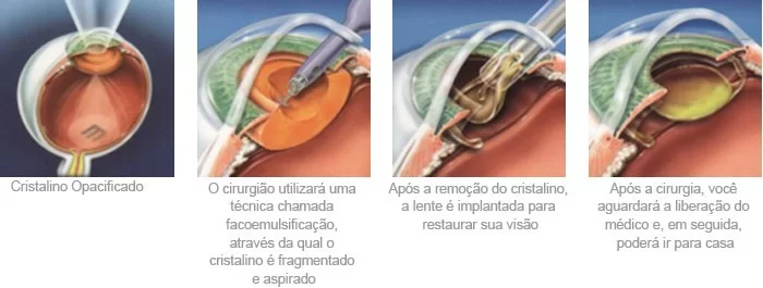 passo_a_passo_catarata.png
