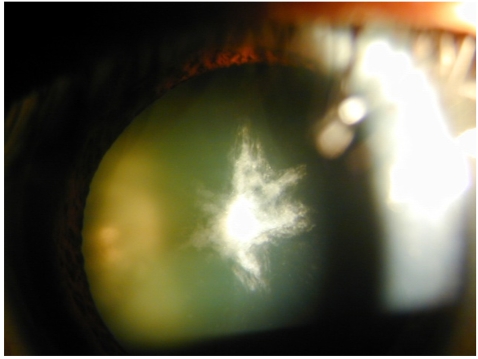 Anterior-polar-cataract-Courtesy-of-Choun-Ki-Joo.png.jpeg