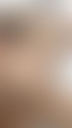 SOLUCIONES PARA NO QUEDARSE CALVO