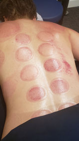 Cupping Marks on client
