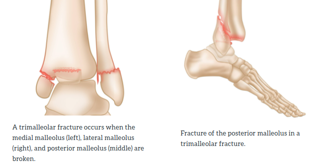 Breaks of a Trimalleolar Fracture