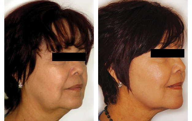 Before and After 10 Venus Freeze treatments at Ink & Glow, Welwyn, Hertfordshire