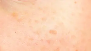 Pigment/Sun Damage, Age Spots