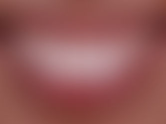 O que é sorriso gengival?