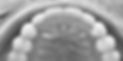 Appareil de contention - Cabinet d'orthodontie de Péronne