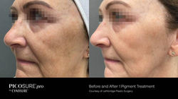 Before and after PicoSure Pro laser correction showing reduced pigmentation, sun damage, and dark sp