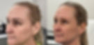 Before and after facial skin treatment results with improved texture and tone.