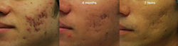 Morpheus8 acne scar treatment progression showing improvement from active acne to reduced scarring a