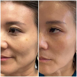Before and after PicoSure laser treatment showing improvement in facial pigmentation, skin tone, and