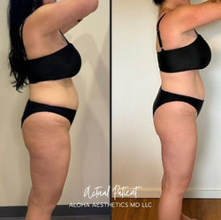 A before-and-after comparison of a female patient showing reduced abdominal fullness and improved bo