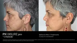 PicoSure Pro laser treatment before and after results showing reduction of facial pigmentation and s