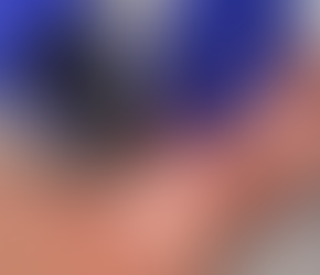 Morpheus8 radiofrequency microneedling treatment for skin tightening and collagen remodeling at a physician-led aesthetic clinic in Kaimuki, Honolulu.