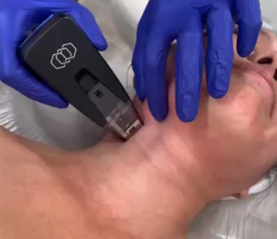 Morpheus8 radiofrequency microneedling treatment for skin tightening and collagen remodeling at a physician-led aesthetic clinic in Kaimuki, Honolulu.