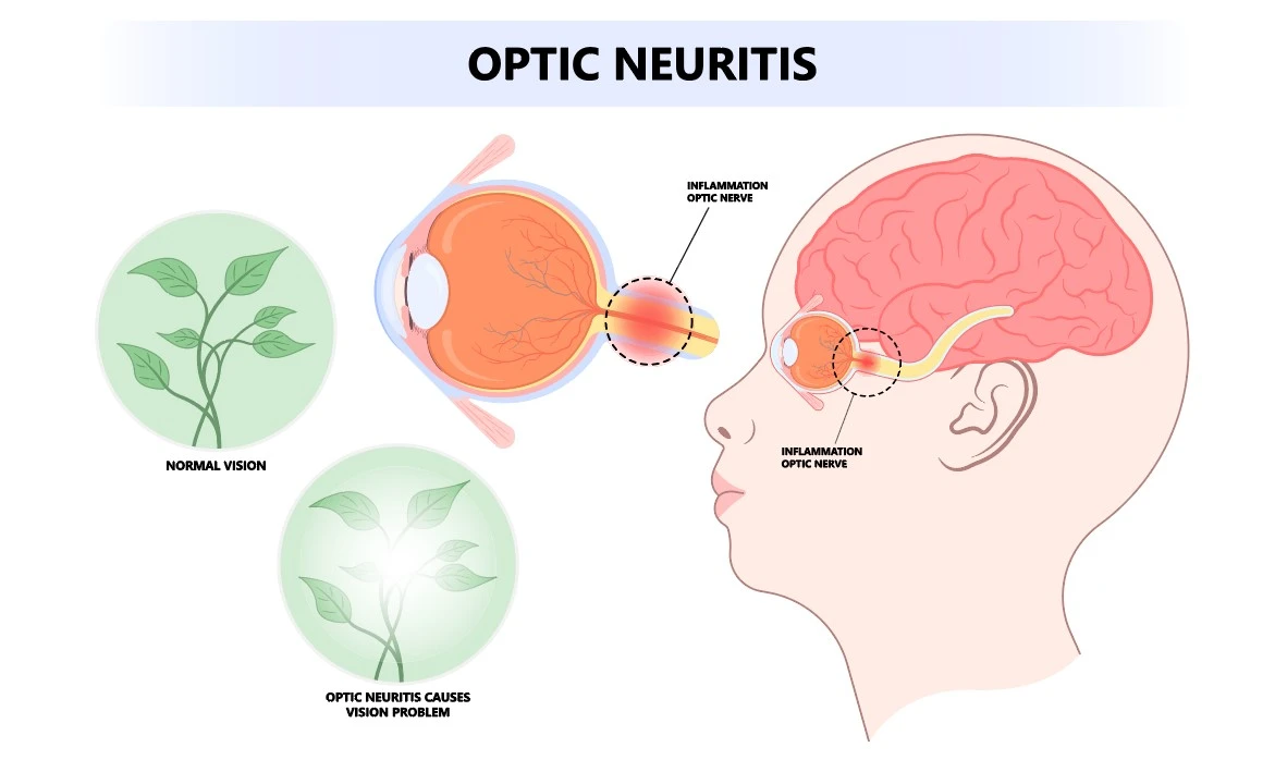 what-is-optic-neuritis.webp
