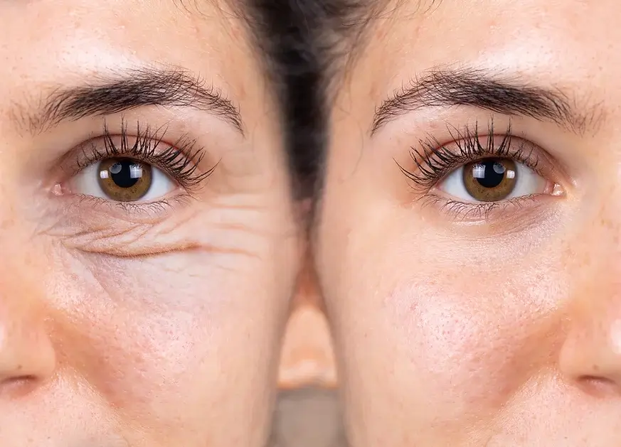 Before and after botox for hooded eyes