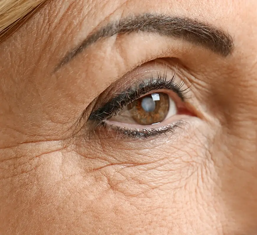 Close up of eye before cataract surgery Lancashire