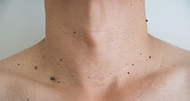 Tina Johnson Personal Aesthetics for skin tag removal in Kent