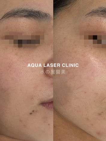 Laser Pigmentation Removal 
