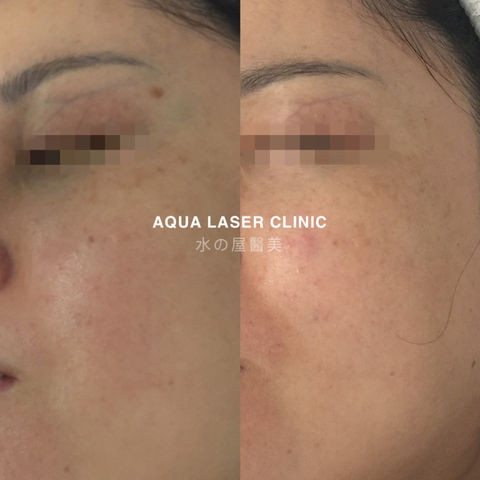 Laser Pigmentation Removal 