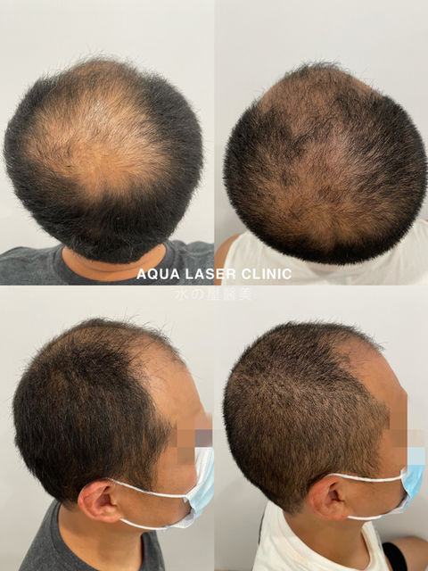 Hair Loss Treatment Before & After