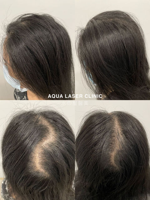 Hair Loss Treatment Before & After