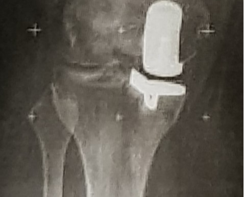 5. 11-2016 Operation Nr. 12 Knie rechts Schlittenprothese