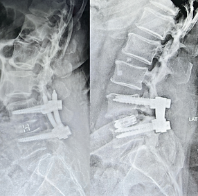 Spine fusion using transforaminal lumbar interbody fusion which can be done by open , MIS & endoscope 