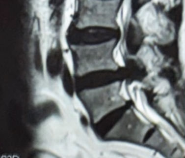 MRI of lumbar spine showing lumbar spinal stenosis at the level of L4-5 