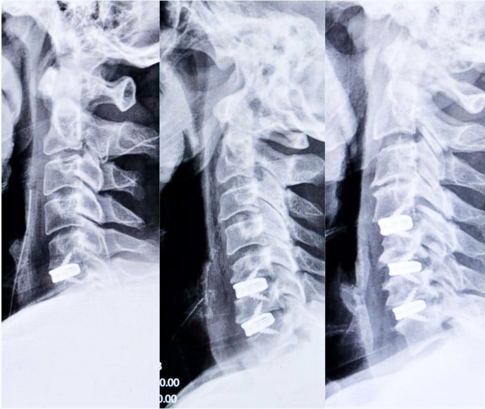 Multiple X-Ray of 1,2,3 levels of anterior cervical discectomy and fusion 