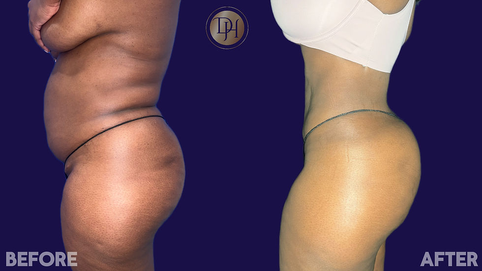 Liposculpting- Side View