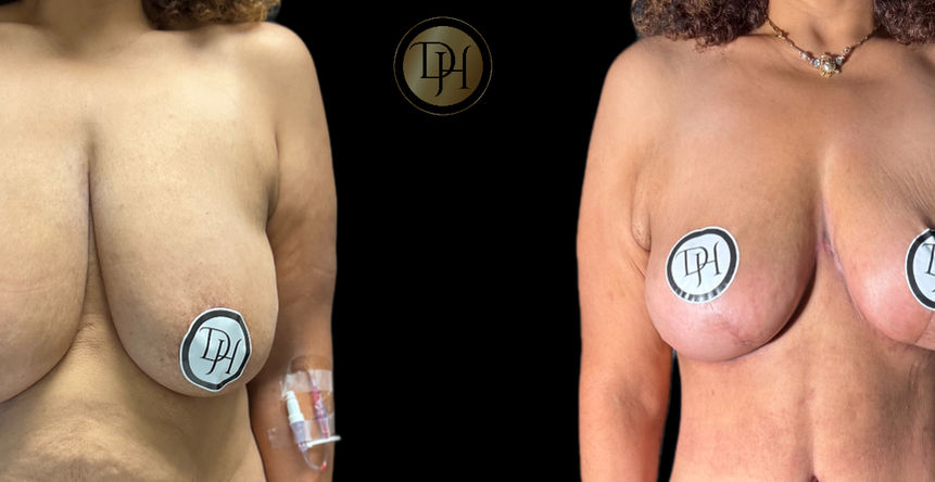 Before and After pictures of breast reduction surgery