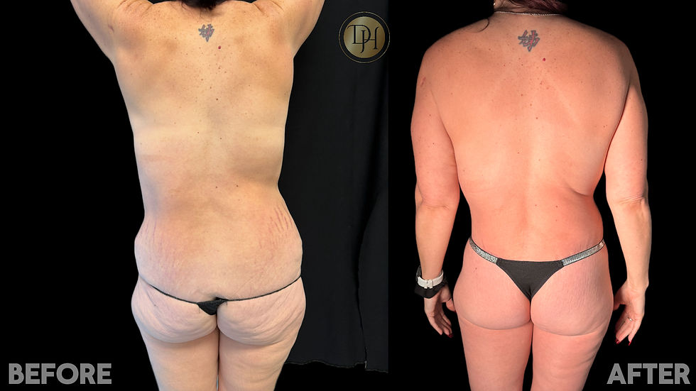 Mommy Makeover- Back View