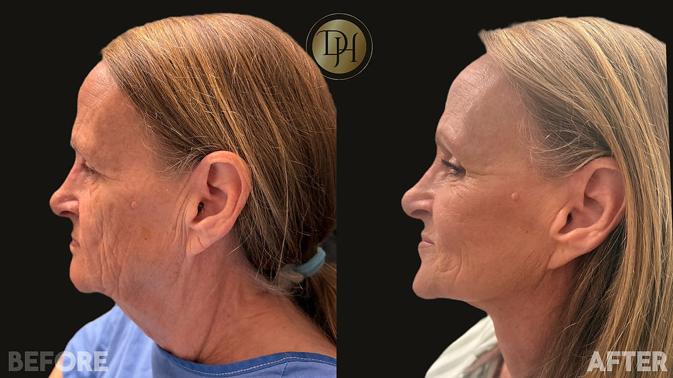 Face & Neck Lift- Side View