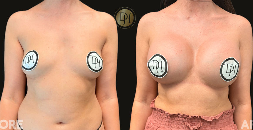 Before and After pictures of breast augmentation surgery