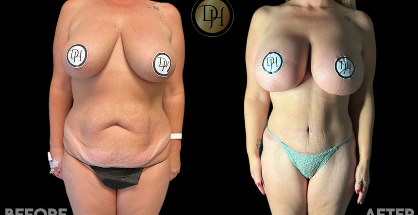 Before and After pictures of Mommy Makeover surgery