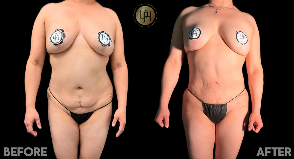 Liposculpting/BBL