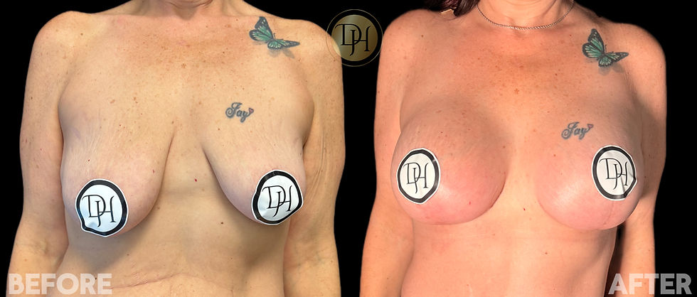 Breast Augmentation + Lift
