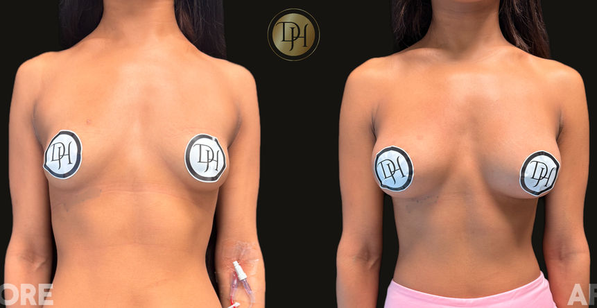 Before and After pictures of Breast Augmentation surgery