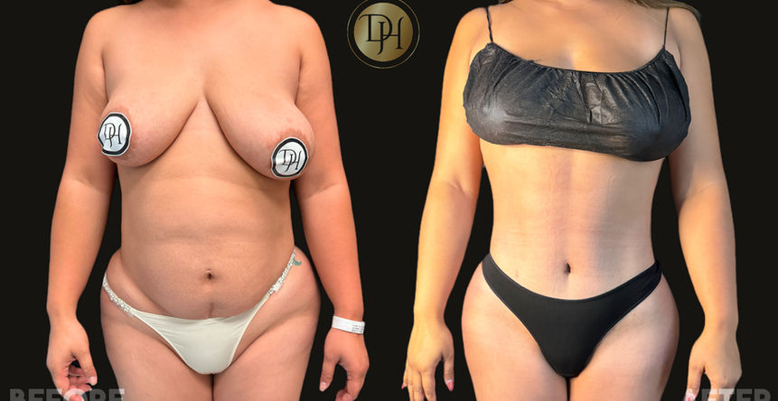 Before and after pictures for tummy tuck/BBL surgery