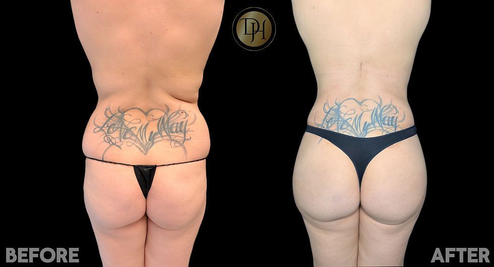 Mommy Makeover- Back View