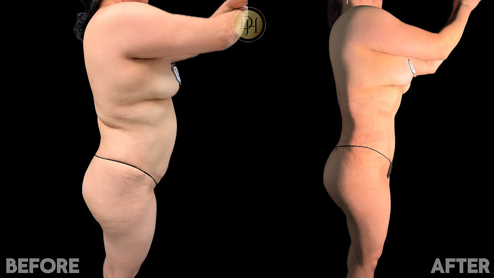 Liposculpting/BBL- Side View