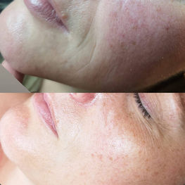 BioRePeel Kur vorher-nachher Ergebnis mit glatterer, strahlender Haut und reduzierten Unreinheiten