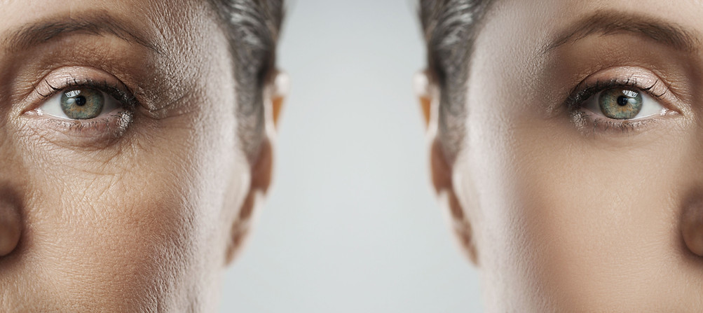 Vorher-nachher Hautbild rund um die Augen nach Microneedling und Nanoneedling – glattere Struktur, weniger Fältchen und sichtbar regenerierte Haut.