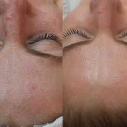 Vorher-Nachher Ergebnis nach Microdermabrasion kombiniert mit Cold Plasma – reduzierte Unreinheiten und ebenmässigeres Hautbild.