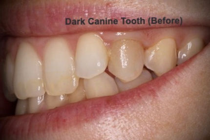 Single tooth is dark and discolored before and after